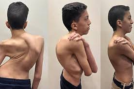 /Scoliosis surgeries